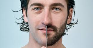 زراعة اللحية بنتائج مضمونة