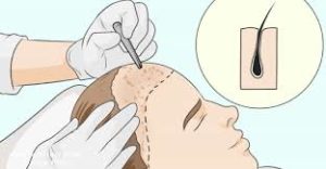 أفضل عروض لزراعة الشعر في تركيا أفضل عروض لزراعة الشعر في تركيا